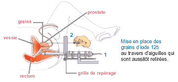 Schéma curiethérapie cancer de prostate