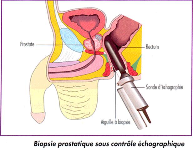 douleur biopsie prostate forum)