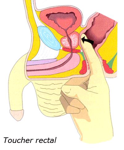 a prostatitis alatt fut