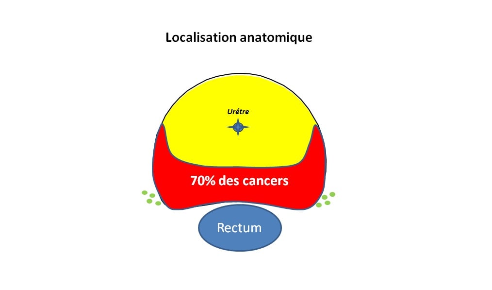 cancer prostate localisation anatomique