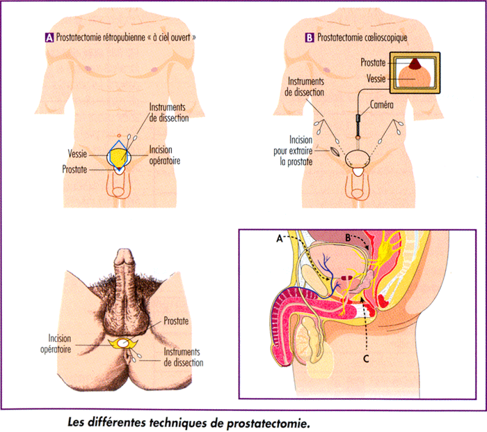 Les différentes techniques de prostatectomie